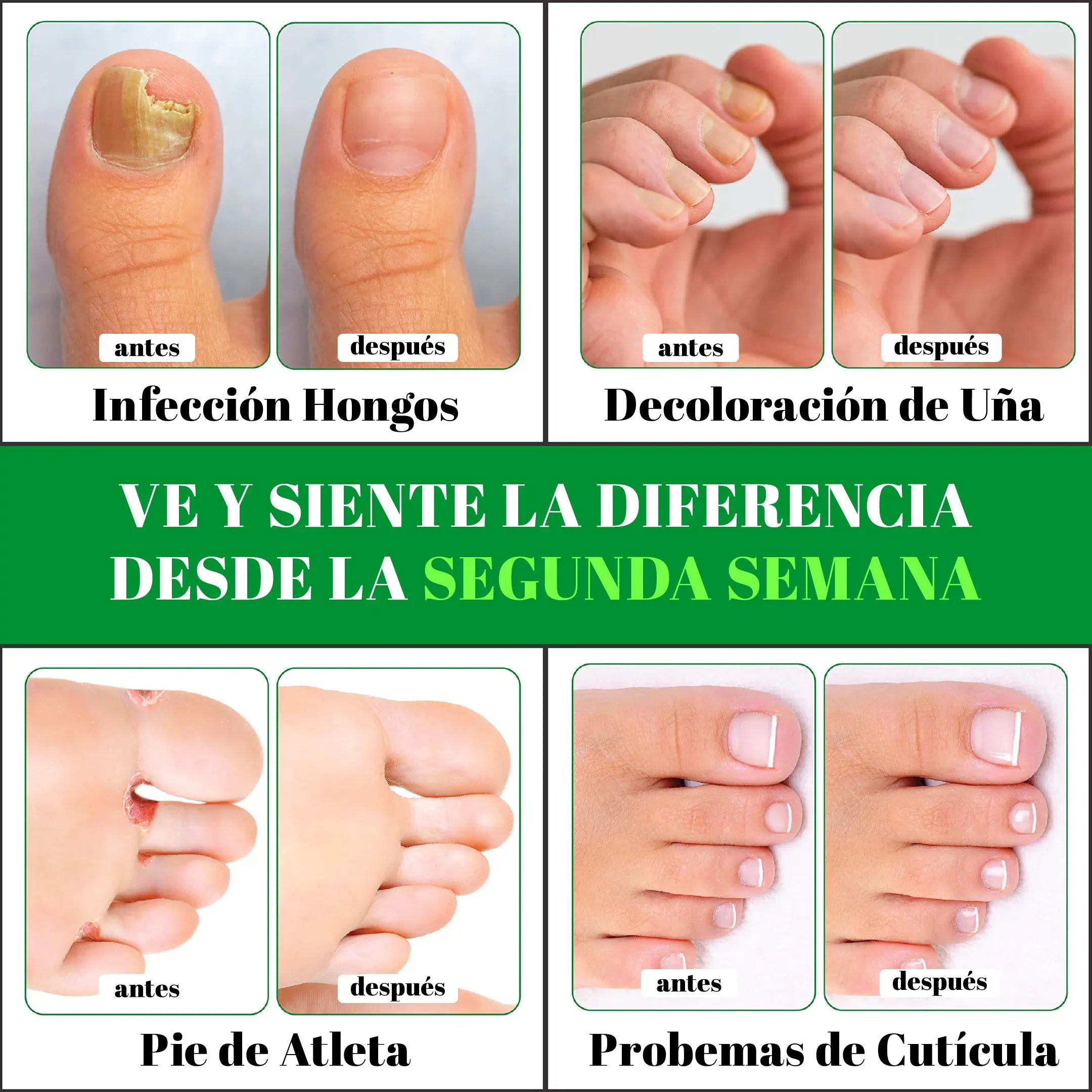FUNGIKICK-Gota para hongos uñas